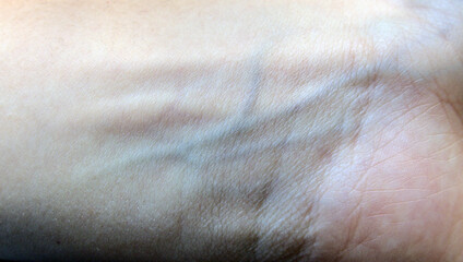 Blue big veins, hand wrist view from inner side close up