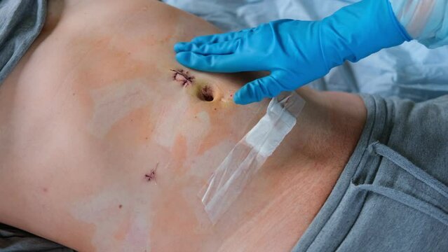 Hands of medic or nurse in blue gloves examining a fresh suture on a male stomach after laparoscopy surgical removal of appendicitis. Doctor examines of the patient. Man belly with medical stitches