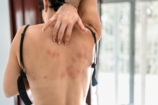 Woman Suffering From Bed Bug Bites in Africa