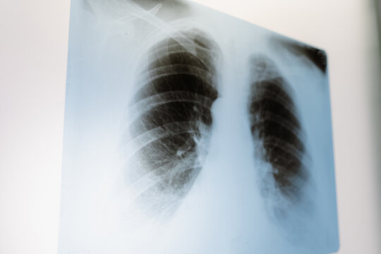 X-ray of the lungs