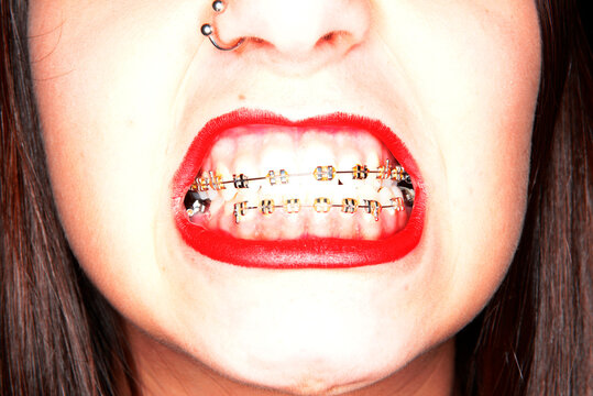 Red lipstick and braces
