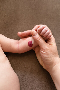 Close up of baby hand with hemangioma