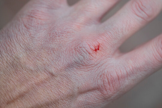 Hand with dry skin
