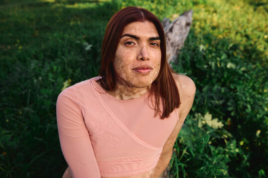 Portrait of a young non-binary person with beautiful vitiligo skin 