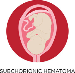 Vector medical illustration of subchorionic hematoma with blood pooling around a fetus.