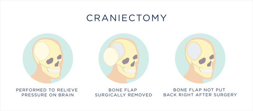 Vector illustration of craniectomy surgical procedure for traumatic brain injury.