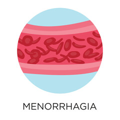 Menorrhagia (heavy blood flow) flat-style vector illustration