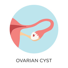 Ovarian cyst flat style vector illustration in circle layout with type, medical infographic