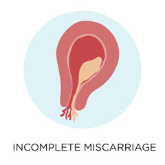 Incomplete miscarriage flat style vector illustration