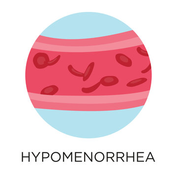 Hypomenorrhea (light blood flow) flat style vector illustration