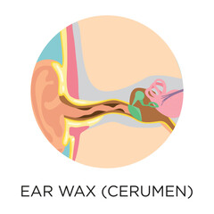 Ear wax (cerumen) flat style vector illustration in circle layout with type, medical infographic