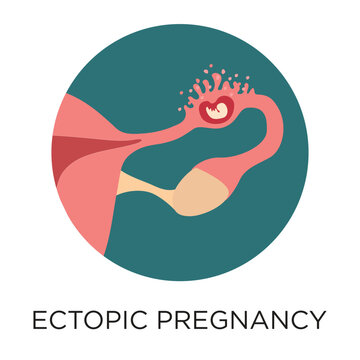 Ectopic pregnancy flat style vector illustration in circle layout with type, medical infographic
