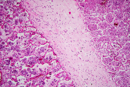 Micrograph of lobar pneumonia haemorrhagic edema period