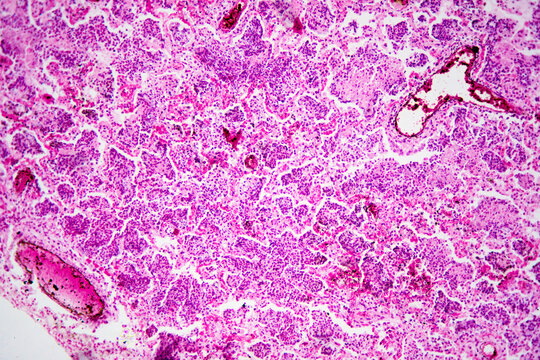 Micrograph of lobar pneumonia haemorrhagic edema period