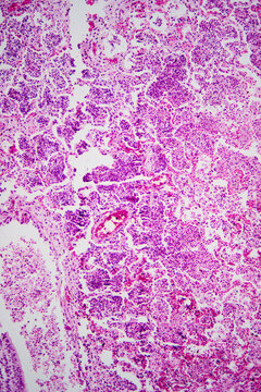 Micrograph of lobar pneumonia haemorrhagic edema period