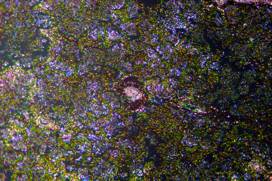 Micrograph of lobar pneumonia haemorrhagic edema period