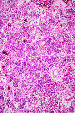 Micrograph of lobar pneumonia haemorrhagic edema period