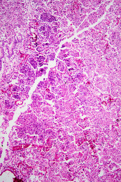 Micrograph of lobar pneumonia haemorrhagic edema period