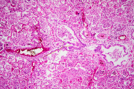 Micrograph of lobar pneumonia haemorrhagic edema period