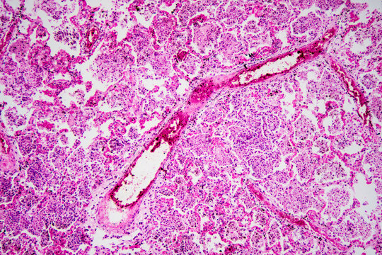 Micrograph of lobar pneumonia haemorrhagic edema period