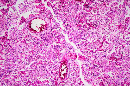 Micrograph of lobar pneumonia haemorrhagic edema period