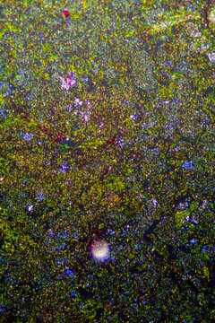 Micrograph of lobar pneumonia haemorrhagic edema period