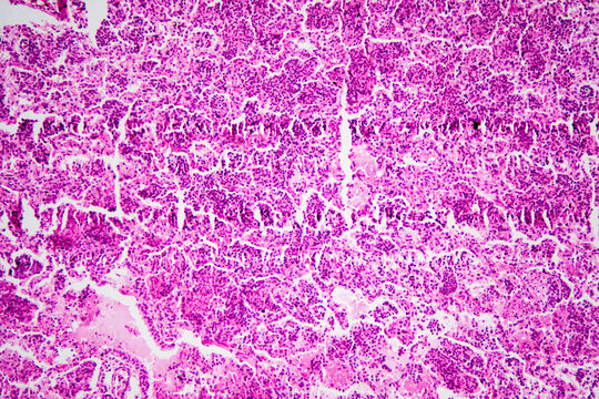 Micrograph of lobar pneumonia haemorrhagic edema period