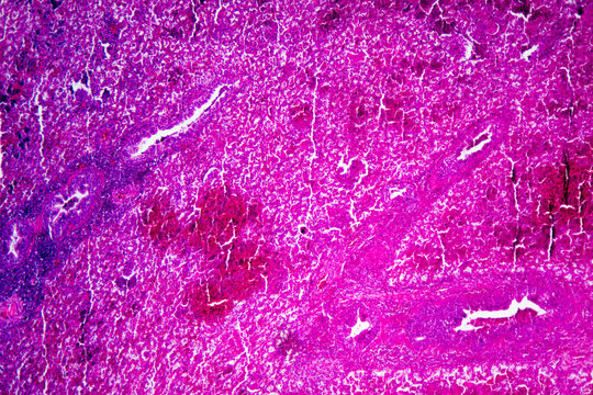 Micrograph of lobar pneumonia red hepatization stage