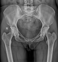 Female Anteroposterior Radiograph of the Pelvic Girdle