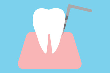 歯周病・歯周ポケットの検査　軽度
