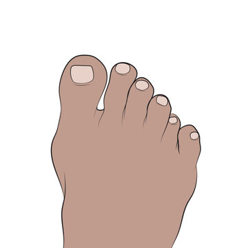 Standing polydactyly can be transmitted from parent to child.
