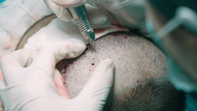 "The doctor is currently performing hair transplant surgery, relocating hair follicles to the hairline corners to address the issue of baldness in the clinic. Slow motion footage."