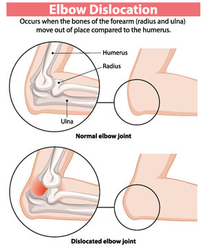 Comparison of normal and dislocated elbow joints