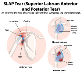 Detailed diagram of SLAP tear in shoulder joint
