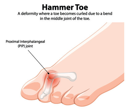 Diagram showing hammer toe deformity and PIP joint
