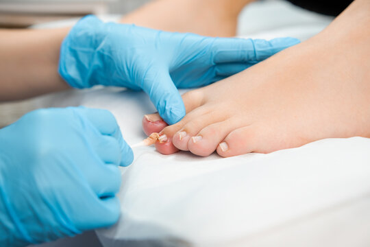 Close up podologist treats the nail with an antifungal agent. 