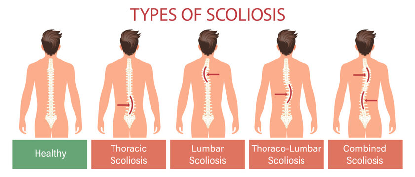 Types of scoliosis, spinal disease. Infographics banner with human scoliosis spine. Healthcare and medicine. Illustration, poster