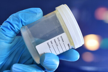 Medical personnel doctor nurse holding urine, semen or stool specimen cup for sample to be tested.