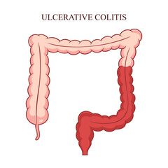 Ulcerative Colitis Vector Design Illustration
