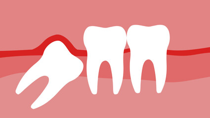 A wisdom tooth grows, flat color illustration