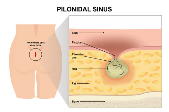 Pilonidal sinus disease vector illustration
