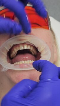Close-up video The dentist puts on gloves and a sterile mouth mirror. Patient wearing safety glasses. Preparing for a medical examination. dentist Dental treatment.