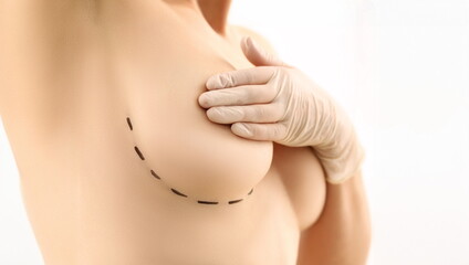 Woman Breasts Plastic Surgery Marker Line Mark. Topless Female with Lines on Skin for Operation on...