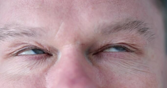 Male blue eyes with nervous tics and strabismus. Facial nervous tics concept