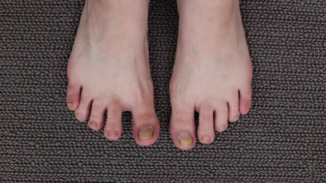 Problems with toenails. Damaged thumb nails. Mycosis on the legs, detaches from the finger. Problems after pedicure, treatment of fingers from disease