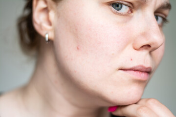 Fototapeta premium Young girl with pimple on her face. Skin problems. Self image issues concept. 