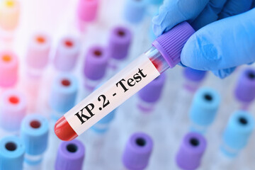 Doctor holding a test blood sample tube for the detection of the virus KP.2 on the background of...