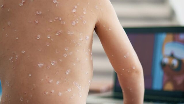 Little girl with chickenpox or varicella watches cartoons while staying at home for quarantine