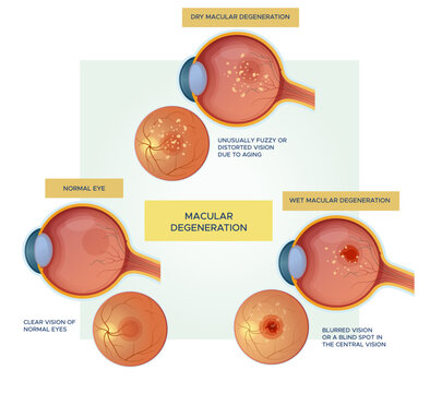 Normal Eyes vs Dry / Wet Macular Degeneration - Stock Illustration