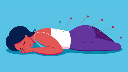 A person lying on their stomach with acupuncture needles p along their back to help relieve tension and improve overall health.. Vector illustration
